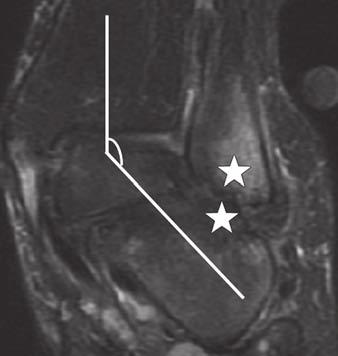 ligament traction on fibula. B Fig. 10 Distal fibular tip bone marrow edema.