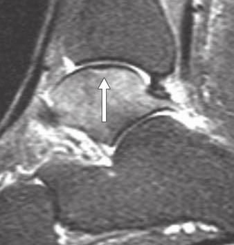 (black oval) Medial Contusion (black dots) Osteochondral injury Tibiotalar arthropathy (white asterisks) Deltoid avulsion (dotted line) Posterior Posterior impingement (white star) PTFL traction
