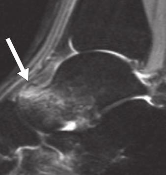 Sagittal STIR image of 76-year-old woman shows diffuse talar bone marrow edema associated with focal flattening and low signal of talar articular surface (arrow).