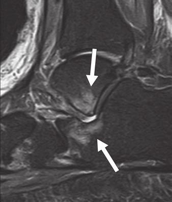 18 Posterior talar impingement. Sagittal STIR image of 37-year-old man shows bone marrow edema in posterior talus as a result of enlarged Stieda process (star) impinging against calcaneus.