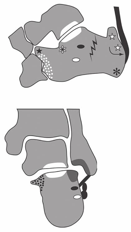(white asterisk) (black dots) Fig. 19 Talocalcaneal impingement as a result of flatfoot deformity and hindfoot valgus.