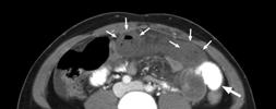 The best initial study is a CT abdomen/pelvis with IV contrast and without (positive) oral contrast Can any tests differentiate patients whose non-strangulating obstruction will resolve