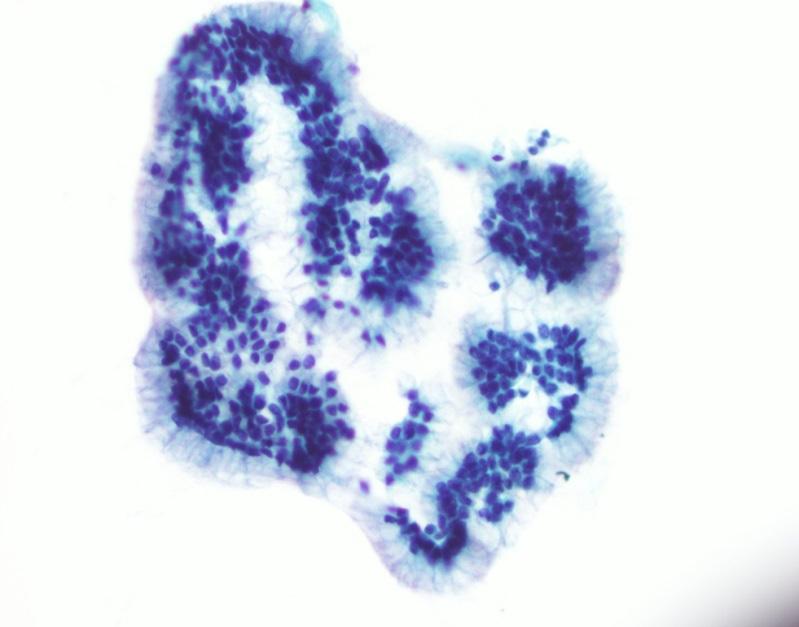 Cystic Neoplasms Serous cystadenomas uniformly benign Mucinous neoplasms at least premalignant 5