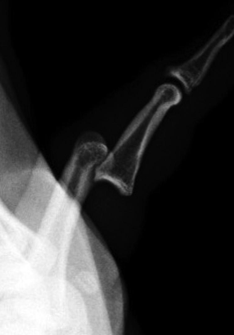 fracture of the middle phalanx and other associated injuries.