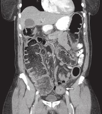 If there is doubt, a barium enema or cross-sectional imaging is required to show the presence of an obstructing lesion or the patency of the colonic lumen (Figs. 3 and 4).