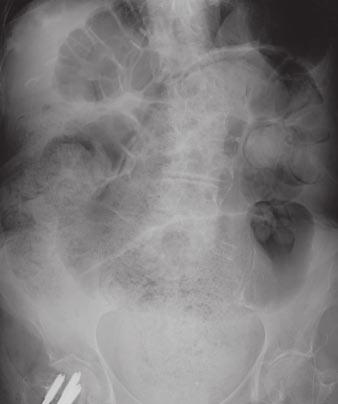 Krajewski et al. Fig. 9 Fecal impaction. bdominal radiograph shows obstruction caused by impaction of large amount of stool filling entire colon and rectum.