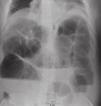 Note presence of rectal air. Fig. 11 Ogilvie s syndrome.