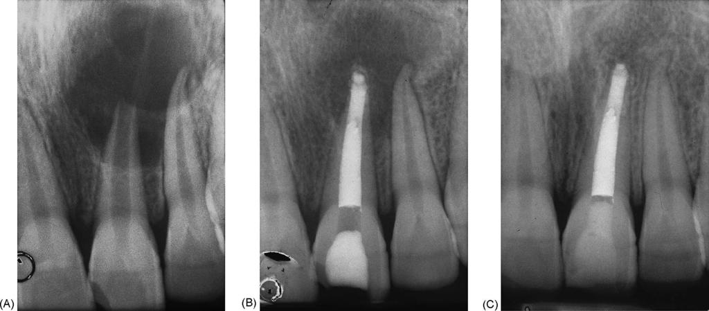 Giuliani et al. Fig. 1. (A) A preoperative radiograph of maxillary left central incisor with an open apex. (B) Follow-up after 6 months. (C) Follow-up MTA Carrier 1.6 mm.