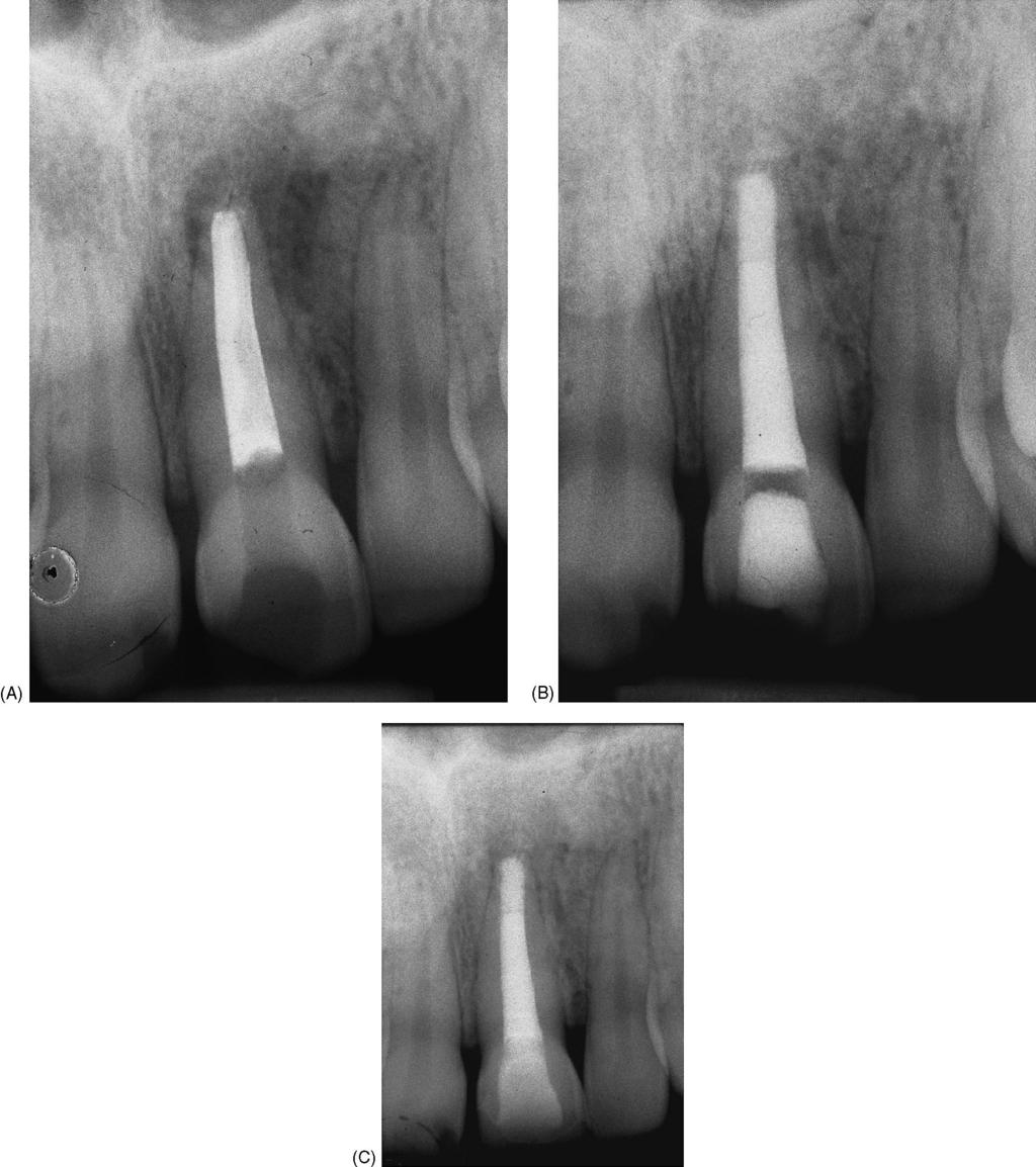 Three clinical cases Fig. 3. (A) A preoperative radiograph of right central incisor with endodontic therapy. (B) Follow-up after 6 months. (C) Follow-up at1year (Fig.