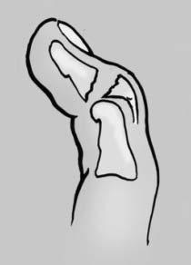 Mallet Finger Occurs with forced flexion of the extended DIP joint Results in: Stretching or tearing of