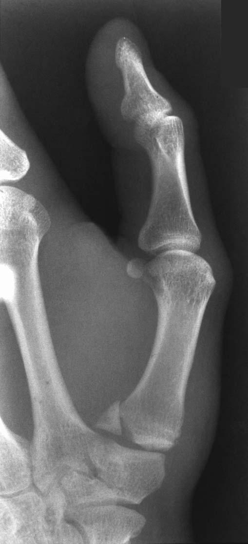 Bennett fracture 2 part intra-articular fracture/dislocation of base of 1st metacarpal Small fragment of 1st
