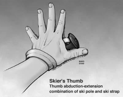 Gamekeeper s Thumb Commonly referred to as Skier s Thumb Most commonly seen in snow