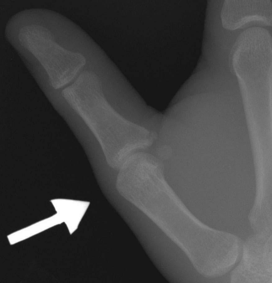 Gamekeeper s Thumb Radiographs may be useful May depict a small avulsion