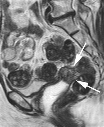 5 and 6), and adenomyosis. Nabothian cysts may be confused with cystic cervical malignancy [3], and clear delineation of the outer cervical contour by vaginal gel may be helpful in some cases.