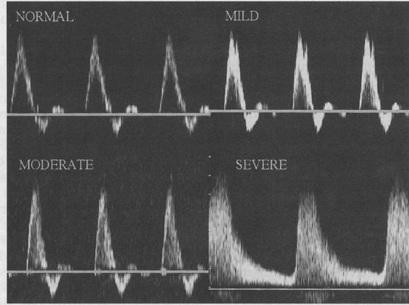 Non-Invasive Imaging: Doppler Ultrasound Findings in severe stenosis Increased peak systolic velocity Pellerito JS. Current approach to peripheral arterial sonography.