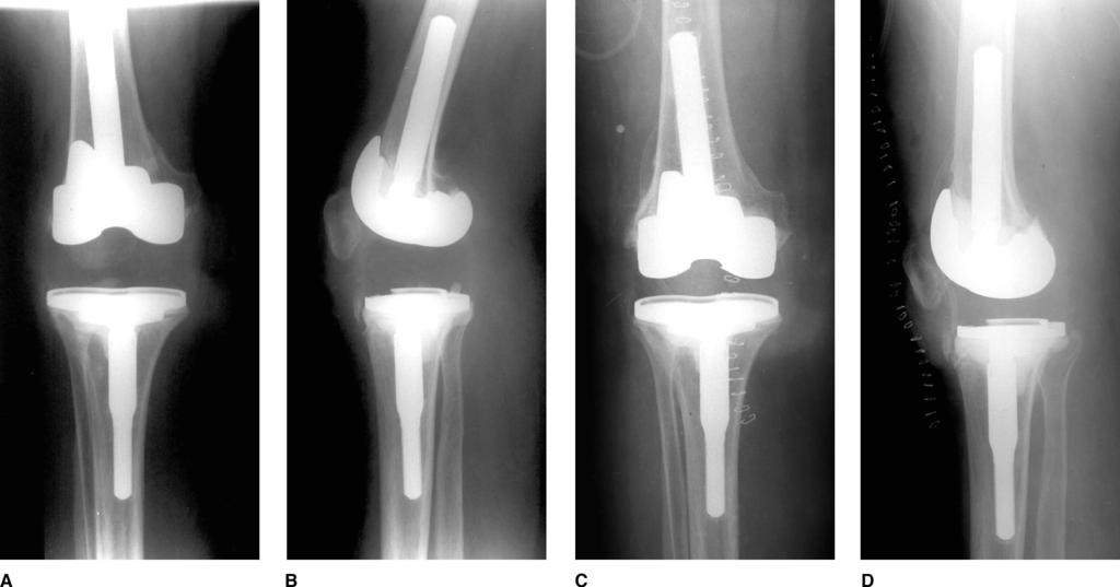 Stiffness After Total Knee Arthroplasty Figure 1 Anteroposterior (A) and lateral (B) radiographs of a 60-year-old woman 1 year after revision TKA.