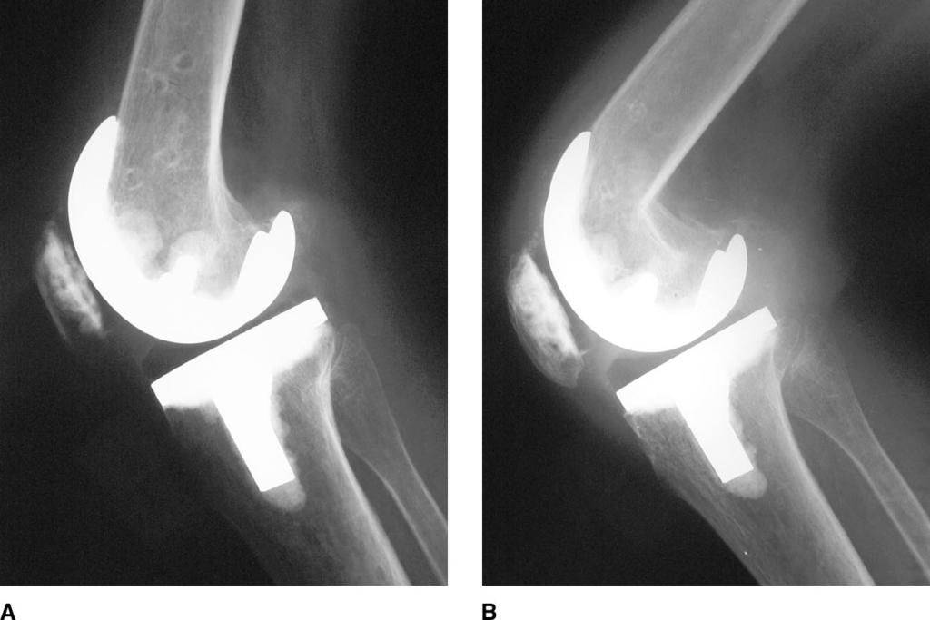 Stiffness After Total Knee Arthroplasty Figure 2 Premanipulation (A) and postmanipulation (B) lateral radiographs of a 48-yearold man with a supracondylar distal femur fracture that occurred during