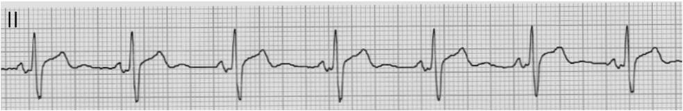 41 DDD Pacing: Atrial Tracking State DDD Pacing: Atrial