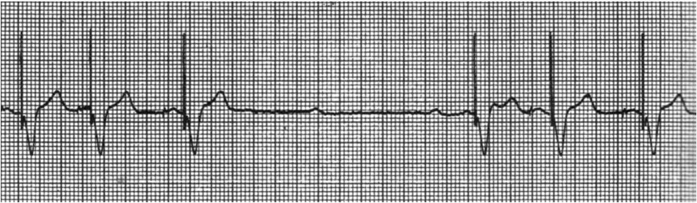 Primary Potential Problems 49 Failure to Pace / Fire / Release Impulse Failure to Capture (depolarization) Failure to Sense Oversensing Undersensing 50 Troubleshooting Pacemakers Failure to Pace