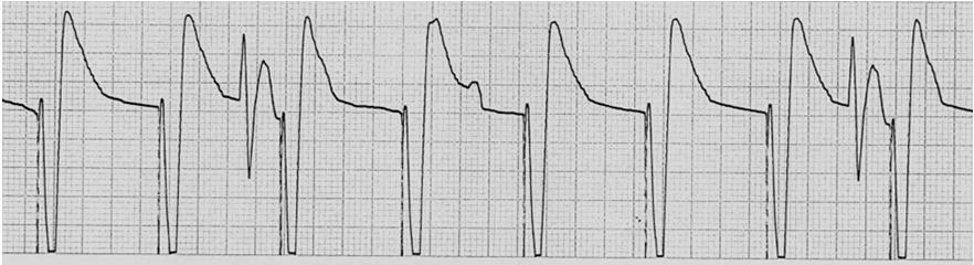 Troubleshooting Pacemakers 55 Interventions for Failure to Capture Emergently treat patient as condition requires Position patient on left side May need lead repositioned or replaced Increase MA