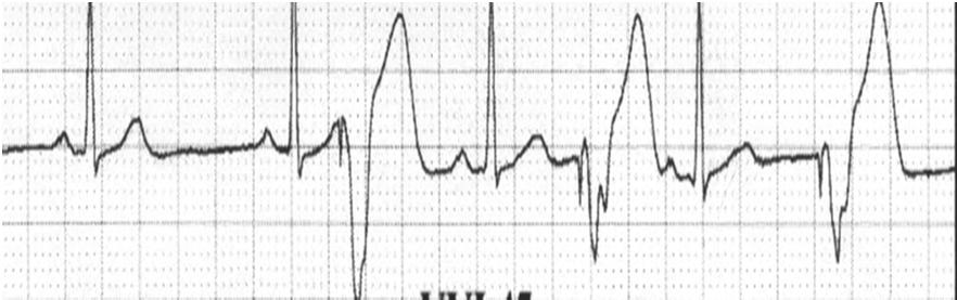Sensitivity: The Fence 57 Sensitivity too low (fence too high) Pacer can t see QRS Sensitivity too high (fence too low) Pacer hallucinates Troubleshooting Pacemakers 58 Causes of