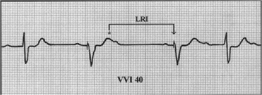 Troubleshooting Pacemakers 59 Interventions for Undersensing Emergently treat patient as condition requires Position on left side Lead positioning or replacement may be necessary Make sure pacer is