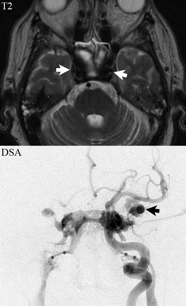 The frontal DSA projection from a left internal carotid artery injection reveals the shunt into the left cavernous sinus,