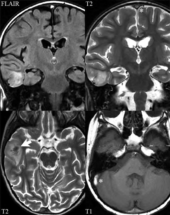 Venous thrombosis with venous infarction Vasogenic edema is noted in the right temporal lobe (arrow), but specifically not in an arterial vascular distribution.