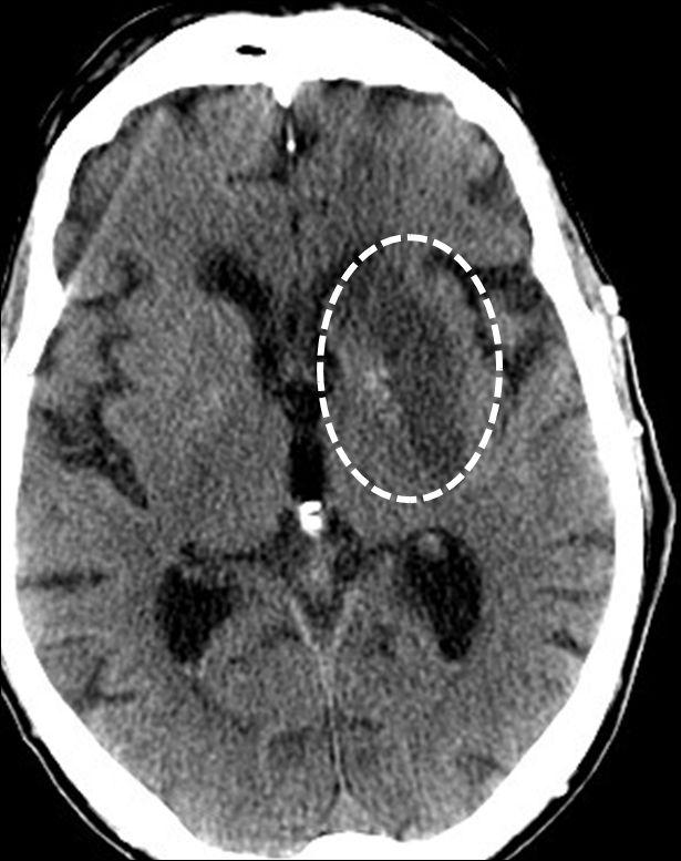 12 Figure 2. Non-contrast CT scan of the head (day 6 of hospital stay), demonstrating hypodensity within basal ganglia suggesting infarction (circle).