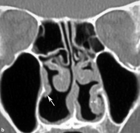 (asterisks), wide bilateral middle meatal antrostomies, and left internal ethmoidectomies Note the persistent polypoid mucosal disease in the right anterior ethmoid sinus.