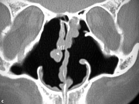 c,d A different patient with extensive FESS showing by coronal (c) and axial CT (d), loss of all lateral wall landmarks bilaterally, except for the right middle turbinate (MT) Uncinectomy and