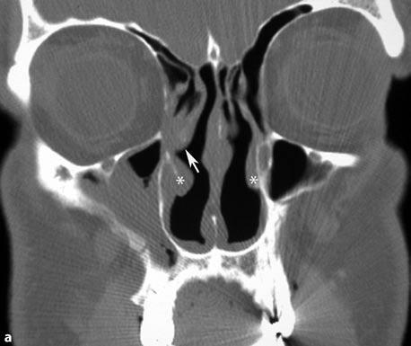 Imaging Anatomy in Revision Sinus Surgery Fig. 1.4a,b Lateralized middle turbinate in a patient 4 months after FESS, with recurrent facial pain and fever.