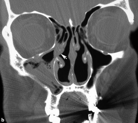 maxillary sinus. Note also subtotal resection of both inferior turbinates (asterisk) Fig. 1.5a,b Residual uncinate process.