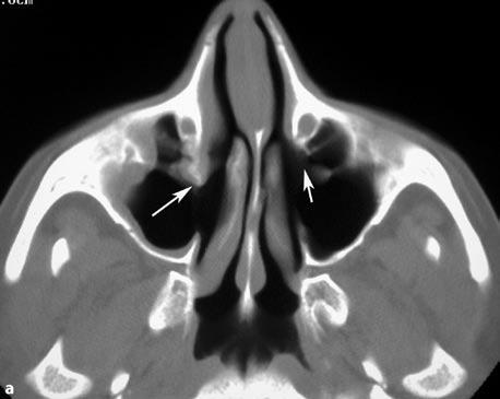 Note the persistent active mucosal thickening in both maxillary sinuses, which is worse on the right side tium, which would result in a maxillary sinusotomy not bearing mucociliary