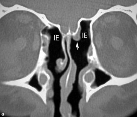 1 (Fig. 1.6). It is important that residual opaque ethmoidal air cells are identified, since they may be an indicator for recurrent sinus disease.