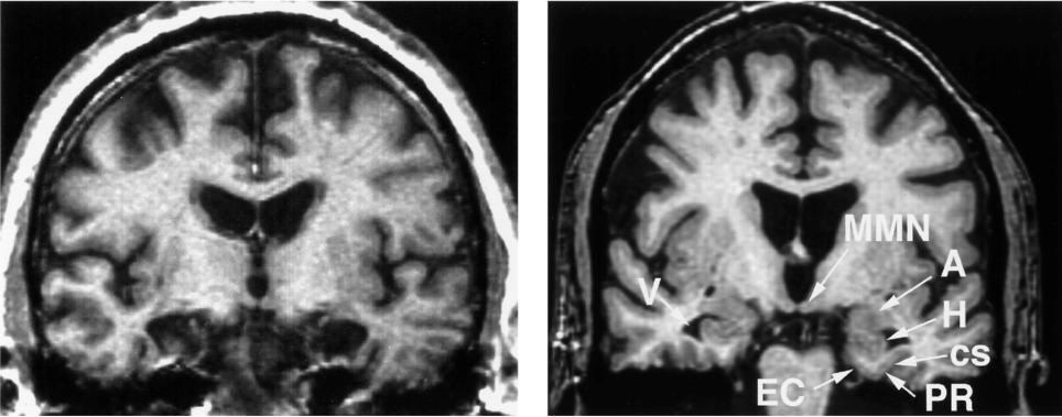 H.M. s bilateral medial temporal lobe resection on MRI H.M. normal brain EC entorhinal cortex, MMN medial mammillary nucleus; A amygdala; H hippocampus CS