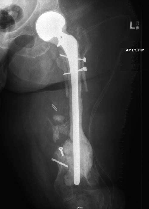 Custom Total Femur Spacer and Second-Stage Total Femur Arthroplasty Sherman et al 783 Because no femur spacer was commercially available or ever manufactured at our institution, a femur spacer was