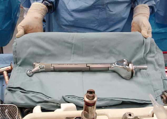 784 The Journal of Arthroplasty Vol. 23 No. 5 August 2008 complaints of pain and was ambulating with a cane, full weight bearing.