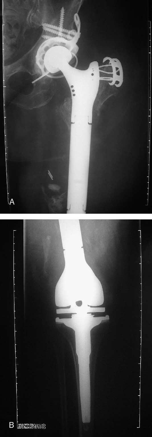 This is an intraoperative photograph of the actual total femur arthroplasty. that an antiprotrusion cage construct was used with bone grafting and a cemented constrained liner.
