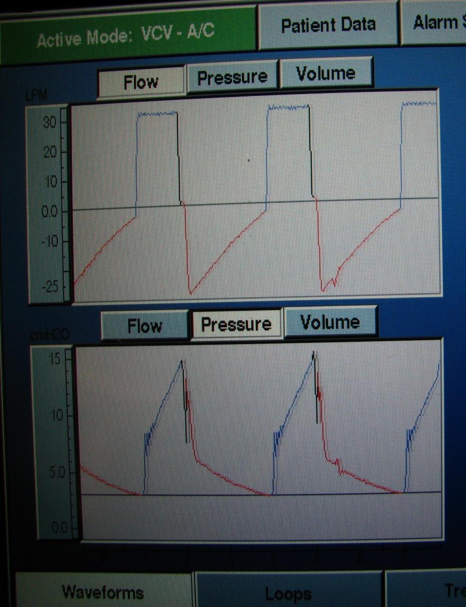 Detecting Auto-PEEP Recognize Auto-PEEP when Expiratory flow continues