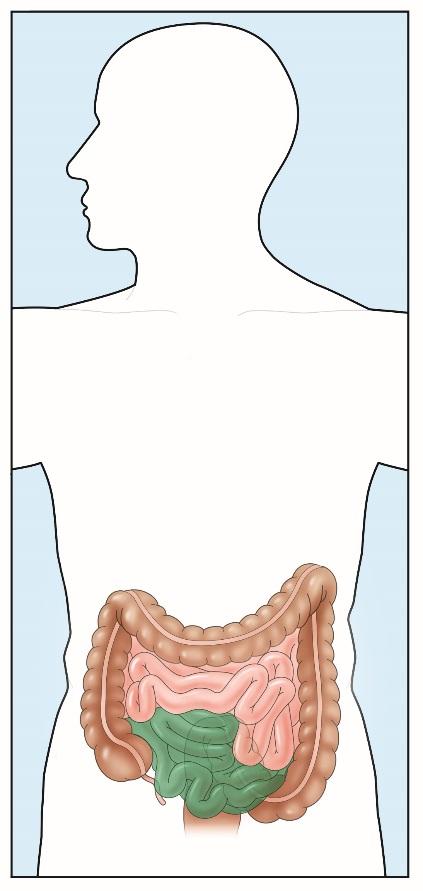 INFLAMMATORY BOWEL DISEASE (IBD): CROHN S DISEASE What is Crohn s Disease? Crohn s disease is a type of inflammatory bowel disease (IBD).