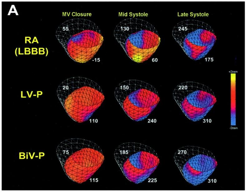 Summary To avoid the abnormal activation during ventricular pacing, the strategies