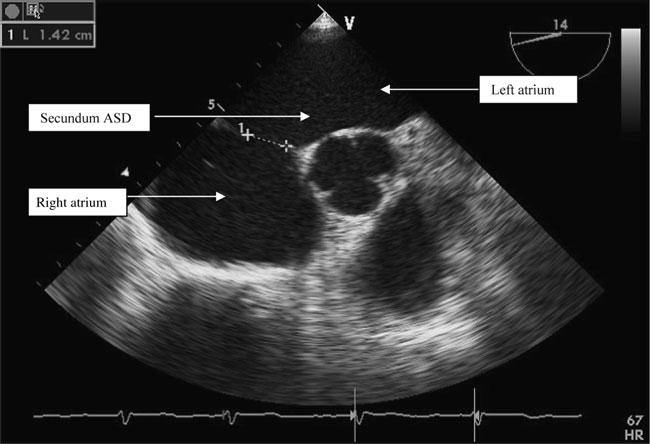 Closure of atrial septal defects Venous thrombosis is often presumed to have been present but may not be identified.