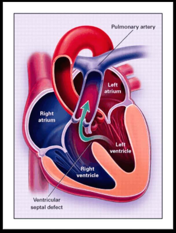 VENTRICULAR SEPTAL DEFECT PHYSIOLOGY Systolic volume load Volume load on pulmonary vasculature and left heart LA and LV enlargement result