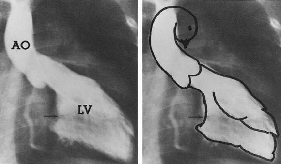 ATRIOVENTRICULAR SEPTAL DEFECT LEFT VENTRICULAR OUTFLOW TRACT