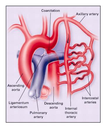 COARCATION OF THE AORTA ANATOMY Generally occurs at ductus arteriosus 5-8% of congenital heart disease