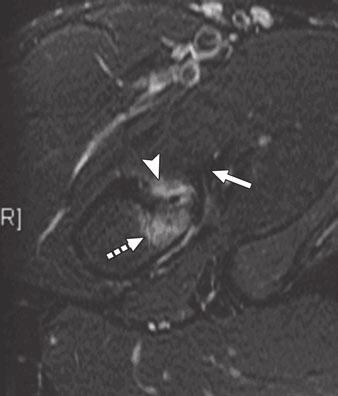A, Coronal fat-suppressed T2-weighted image shows marrow edema in lesser trochanter (solid arrow) extending to inferomedial femoral neck (dashed arrow).
