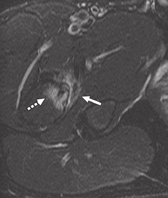 arrow, C), thickening of iliopsoas tendon (solid arrow), and soft-tissue edema surrounding tendon. Periosteal edema (arrowhead, B) is evident along femoral neck and lesser trochanter. neck [12].