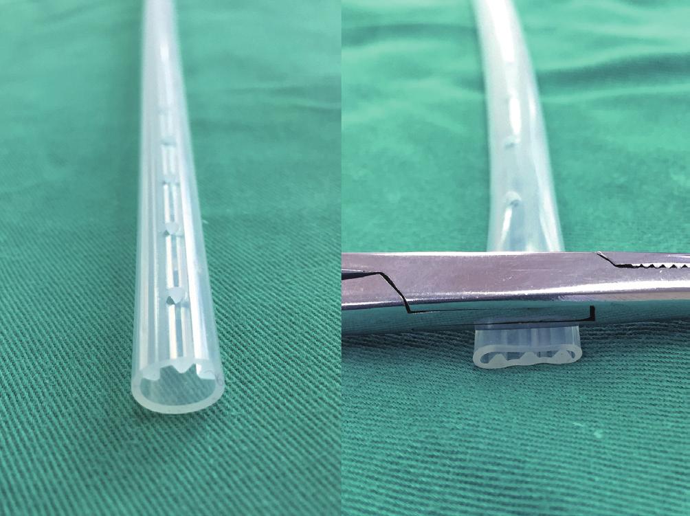 Journal of Thoracic Disease, Vol 8, Suppl 1 February 2016 S97 Figure 4 A silicone fluted drain tube: it has three longitudinal supporting structures over the entire length, 1 mm height and spaced 1