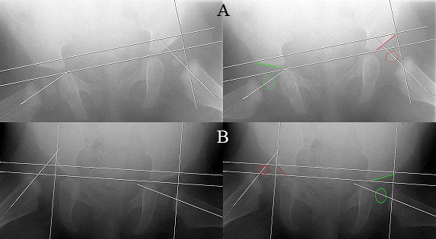 order assess the success rate of the prolonged Pavlik treatment in older infants with congenital hip dislocation we but below the level of the superior acetabular rim, III type 3: capital femoral